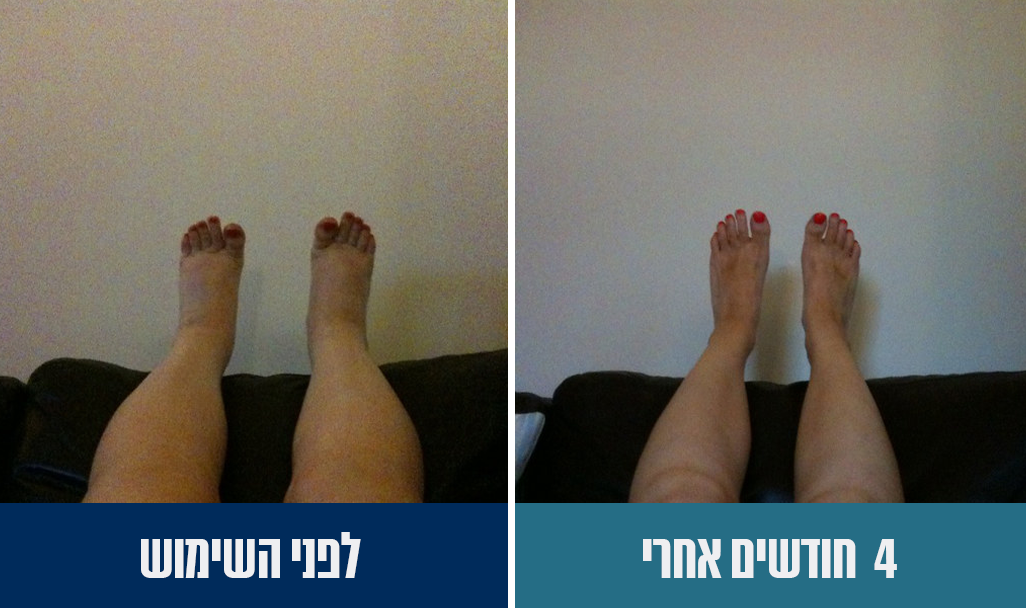 לפני ואחרי שימוש בגרב אלסטית